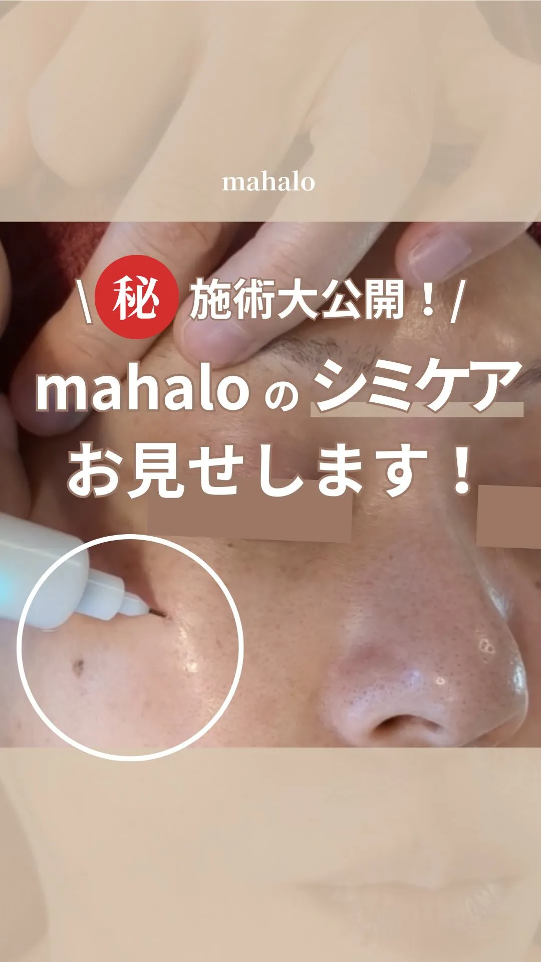 お肌に優しいシミケアで、